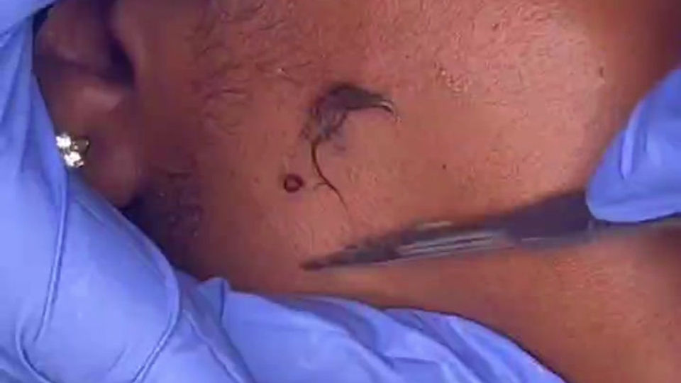 Dermaplaning